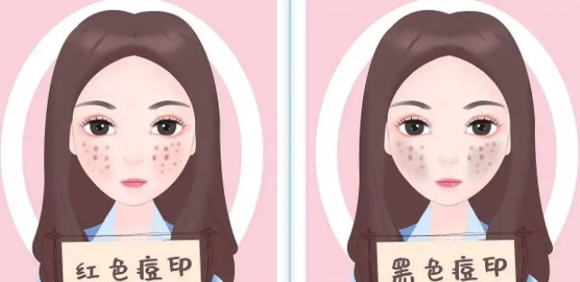 臉上紅色痘印幾個(gè)月都不消怎么辦？紅色痘印應(yīng)該怎么消除？