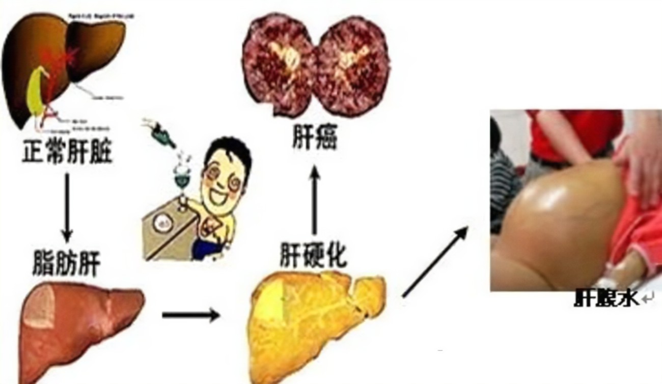 查出肝硬化還有救嗎？